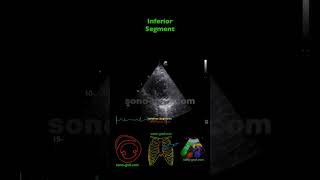 Echocardiography  Inferolateral And Inferior Hypokinesia [upl. by Fairweather]