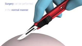 SwannMorton Disposable Retractable Scalpel [upl. by Philan]