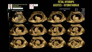 Fetal Hydrops Ascites Hydrothorax [upl. by Delisle765]