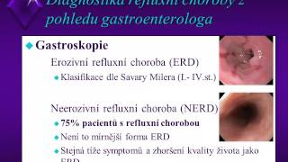 Mimojícnová refluxní choroba a její význam a diagnostika v pneumologii [upl. by Ewart208]