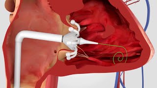 Minimally Invasive Procedures for Structural Heart Disease [upl. by Volnay]