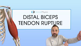 Distal Biceps Tendon Rupture  Expert Physio Review [upl. by Eniagrom]