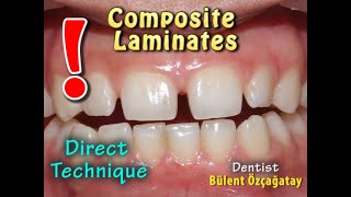 Direct Tehnique Composite Laminates for Gaps Between Teeth [upl. by Phaidra]