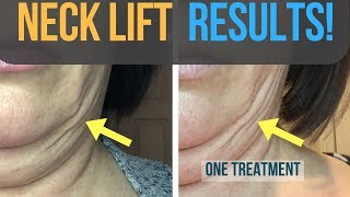 Results From My Fibroblast Plasma Neck Lift [upl. by Karli]