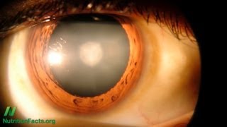 Preventing Cataracts with Diet [upl. by Ahsrav]