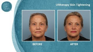 Ultherapy ultrasound painless facelift Dr Melanie Palm San Diego [upl. by Gean839]