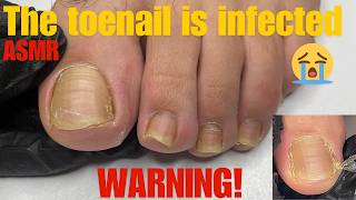 The toenail is infected 😭 pedicure asmr  toenail asmr [upl. by Balcke483]