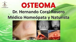 OSTEOMA TUMOR DE HUESOS [upl. by Gefen]