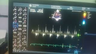 Global hypokinesia of lv severe lv severe TR moderate MR [upl. by Yi257]