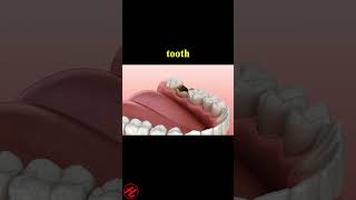 Periostitis tooth  Lump on Gum Above Tooth dentist dentalwellness [upl. by Noeht664]