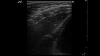 Normal Thymus in Sagittal View [upl. by Ecniv]