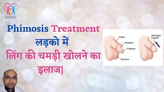 Treatment of Phimosis Cream for Phimosis Home remedy for Phimosis [upl. by Eciruam494]