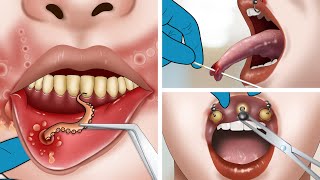 ASMR Mouth ulcer treatment amp removal tongue piercing [upl. by Notluf505]