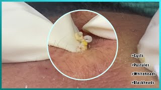 Big Cystic Acne Blackheads Extraction Blackheads amp Milia Whiteheads Removal Pimple Popping [upl. by Novek552]