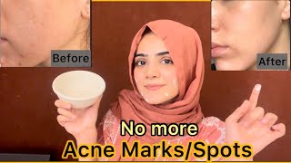 How To Remove Acne Marks Or Spots  Best Easy Home Remedy For Acne  Dietitian Aqsa [upl. by Lewak]