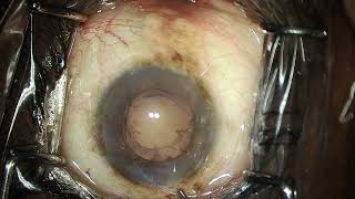 Intumescent cataract Surprise vitreous in AC at the beginning [upl. by Richman]