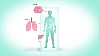 ASMD Facts Chapter 1 What is ASMD and What Causes It [upl. by Dj490]