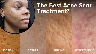 We Treated Acne Scars with Sylfirm X Here’s What Happened [upl. by Sueahccaz]