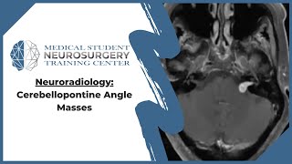 Neuroradiology Cerebellopontine Angle Masses [upl. by Imailiv]