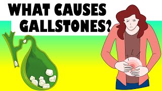 What Causes Gallstones Major Causes Of Gallstone Disease Gallstones Causes [upl. by Sindee804]