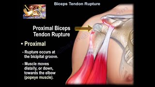 Proximal Biceps Tendon Rupture  Popeye Deformity  Everything You Need To Know  Dr Nabil Ebraheim [upl. by Loella462]