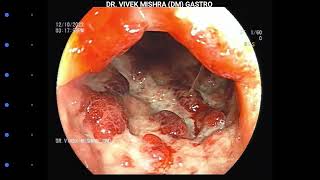 Chronic Ulcerative Colitis  Colonoscopy [upl. by Itnuahsa]