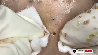 Big Cystic Acne Blackheads Extraction Blackheads amp Milia Whiteheads Removal Pimple Popping [upl. by Anaitat]