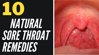 Top 10 Natural Remedies For Sore Throats  10 Natural Sore Throat Remedies [upl. by Lavinia]