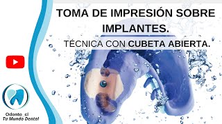 📋GUÍA PASO A PASO Impresión de implantes con cubeta abierta [upl. by Niwdla534]