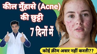 Pimple गायब हो जाएंगे  Adapalene clindamycin gel  Cream for Acne and Pimple [upl. by Macy]