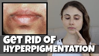 GET RID OF HYPERPIGMENTATION AROUND THE MOUTH DR DRAY [upl. by Kirit]