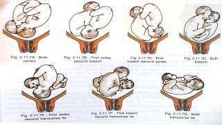 MULTIPLE PREGNANCY LABOR MANAGEMENT [upl. by Einalam685]