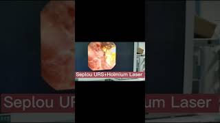 Holmium laser and Seplou URS in lithotripsy kidney stone [upl. by Theron]