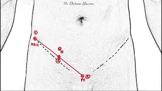 Surface marking of inguinal canal and its clinical correlations [upl. by Rettig]