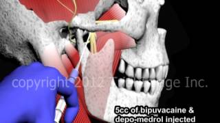 Bupivacaine Anesthesia of the Temperomandibular Joint TMJ  Animation by Cal Shipley MD [upl. by Gnoy666]