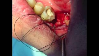 Extraction  os de synthèse  Tooth removal  Geistlich biooss bone substitute [upl. by Niar]