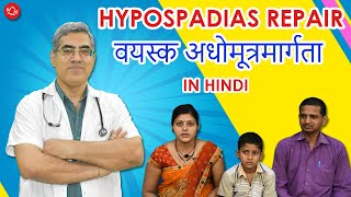 Hypospadias  Hypospadias Repair  वयस्क अधोमूत्रमार्गता पर पूरी जानकारी  Dr Nagwani  India [upl. by Capps]