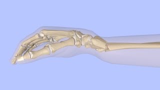 Closed Reduction of a Distal Radius Fracture [upl. by Colfin295]