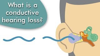 Conductive Hearing Loss Explained [upl. by Mckee407]