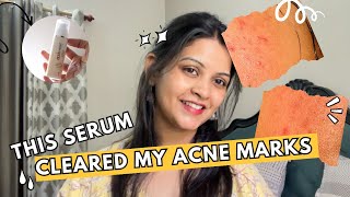 How I cleared my ACNE marks and HYPERPIGMENTATION Best Indian pharmacy Serum [upl. by Ymiaj649]