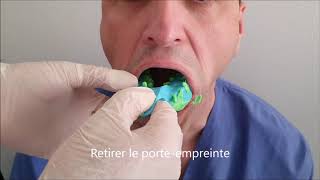 Prise dempreinte dentaire alginate [upl. by Towne]