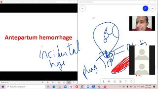 د السكري antepartum hemorrhage APH [upl. by Hploda]