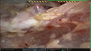 Tumor de Mediastino em Criança HD 720p [upl. by Faxen]