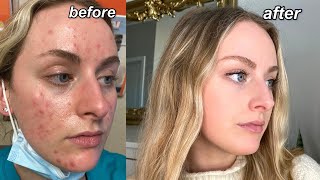 MY ACCUTANE JOURNEY  my acne experience QampA tips  pictures [upl. by Deacon]