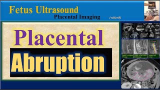 Fetus Ultrasound  Placental Abruption [upl. by Adnalohs]