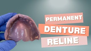 Conversion of Immediate Denture to Permanent Denture with Permanent Hard Reline [upl. by Aihseit]