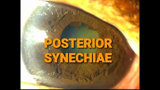 Ep 5 POSTERIOR SYNECHIAECLINICAL DISCUSSION ON SLIT LAMP [upl. by Iamhaj291]