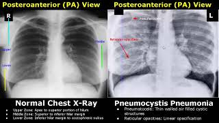 Chest XRay Lung Normal Vs Abnormal Image Appearances Part 1  TBPneumoniaConsolidationCollapse [upl. by Hakon587]