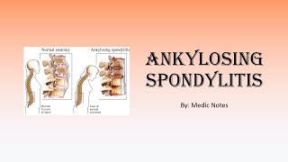 Ankylosing spondylitis  signs and symptoms Schober test Faber test imaging treatment [upl. by Ahcsim]