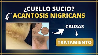 ¿CUELLO SUCIO ACANTOSIS NIGRICANS  Causas y Tratamiento [upl. by Anitnelav650]